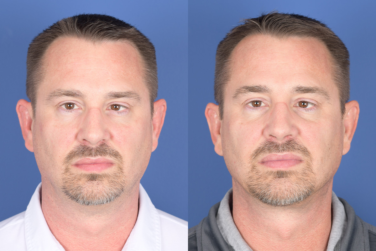 Necklift Before and After | Weber Facial Plastic Surgery