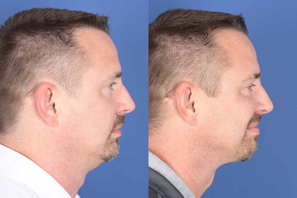 Necklift Before and After | Weber Facial Plastic Surgery