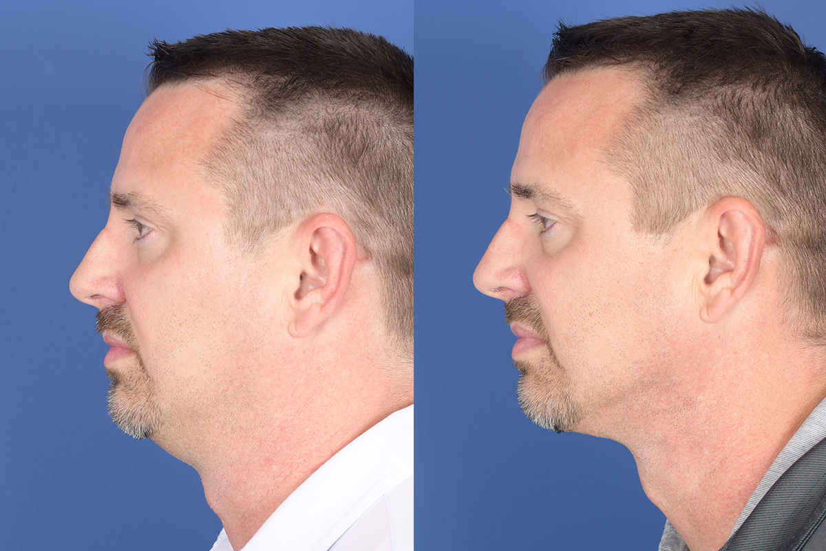 Necklift Before and After | Weber Facial Plastic Surgery
