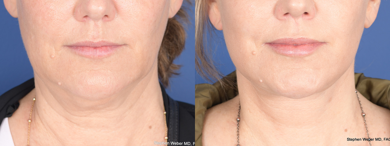 Necklift Before and After | Weber Facial Plastic Surgery