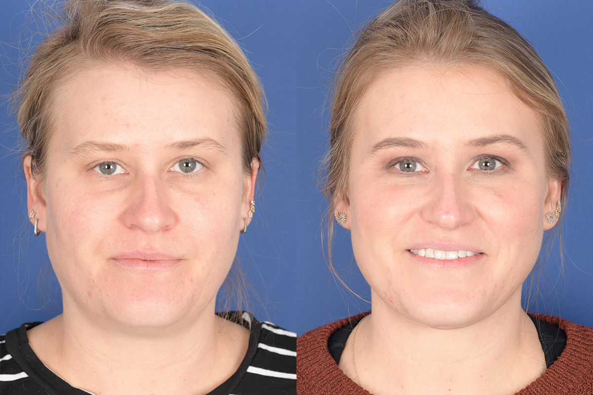 Necklift Before and After | Weber Facial Plastic Surgery