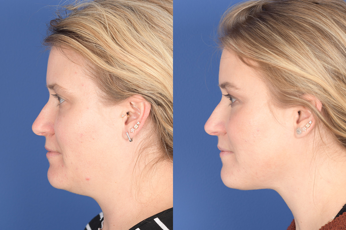 Necklift Before and After | Weber Facial Plastic Surgery