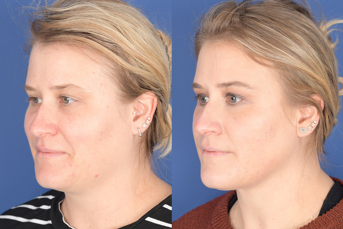 Necklift Before and After | Weber Facial Plastic Surgery