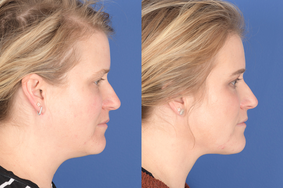Necklift Before and After | Weber Facial Plastic Surgery