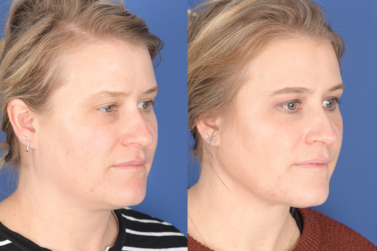 Necklift Before and After | Weber Facial Plastic Surgery