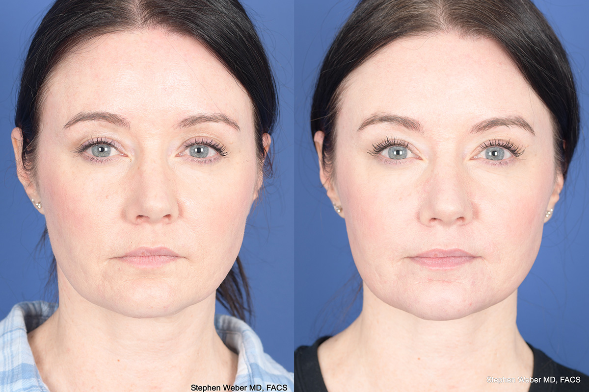 Necklift Before and After | Weber Facial Plastic Surgery