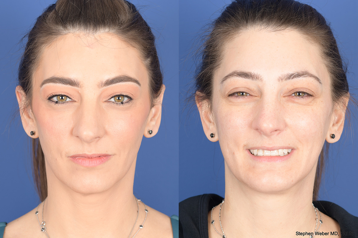 Necklift Before and After | Weber Facial Plastic Surgery