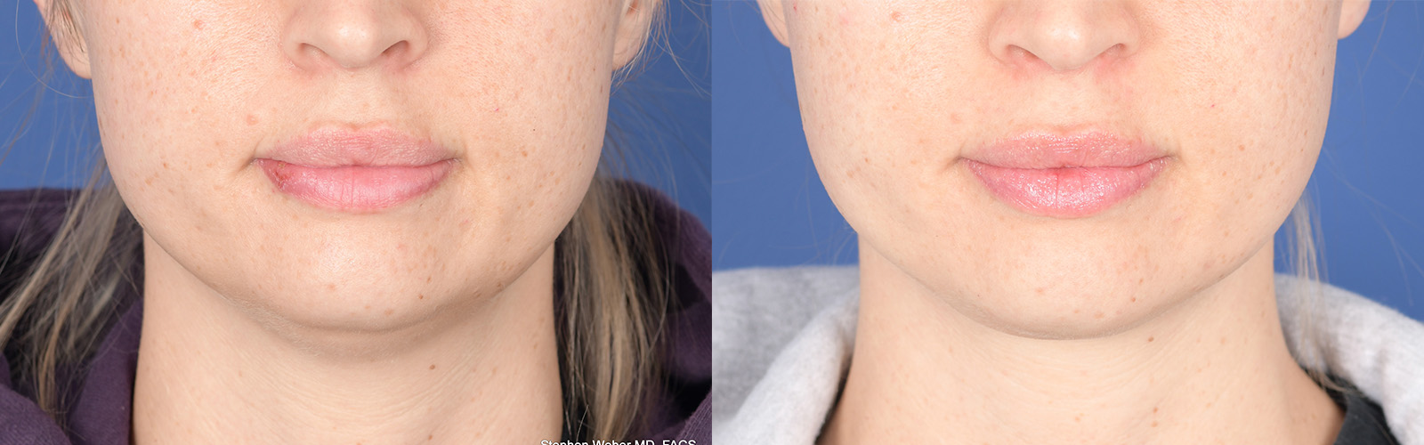 Necklift Before and After | Weber Facial Plastic Surgery