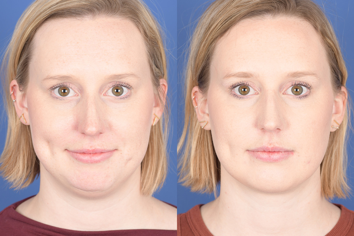 Necklift Before and After | Weber Facial Plastic Surgery