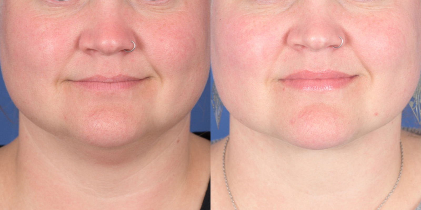 Necklift Before and After | Weber Facial Plastic Surgery