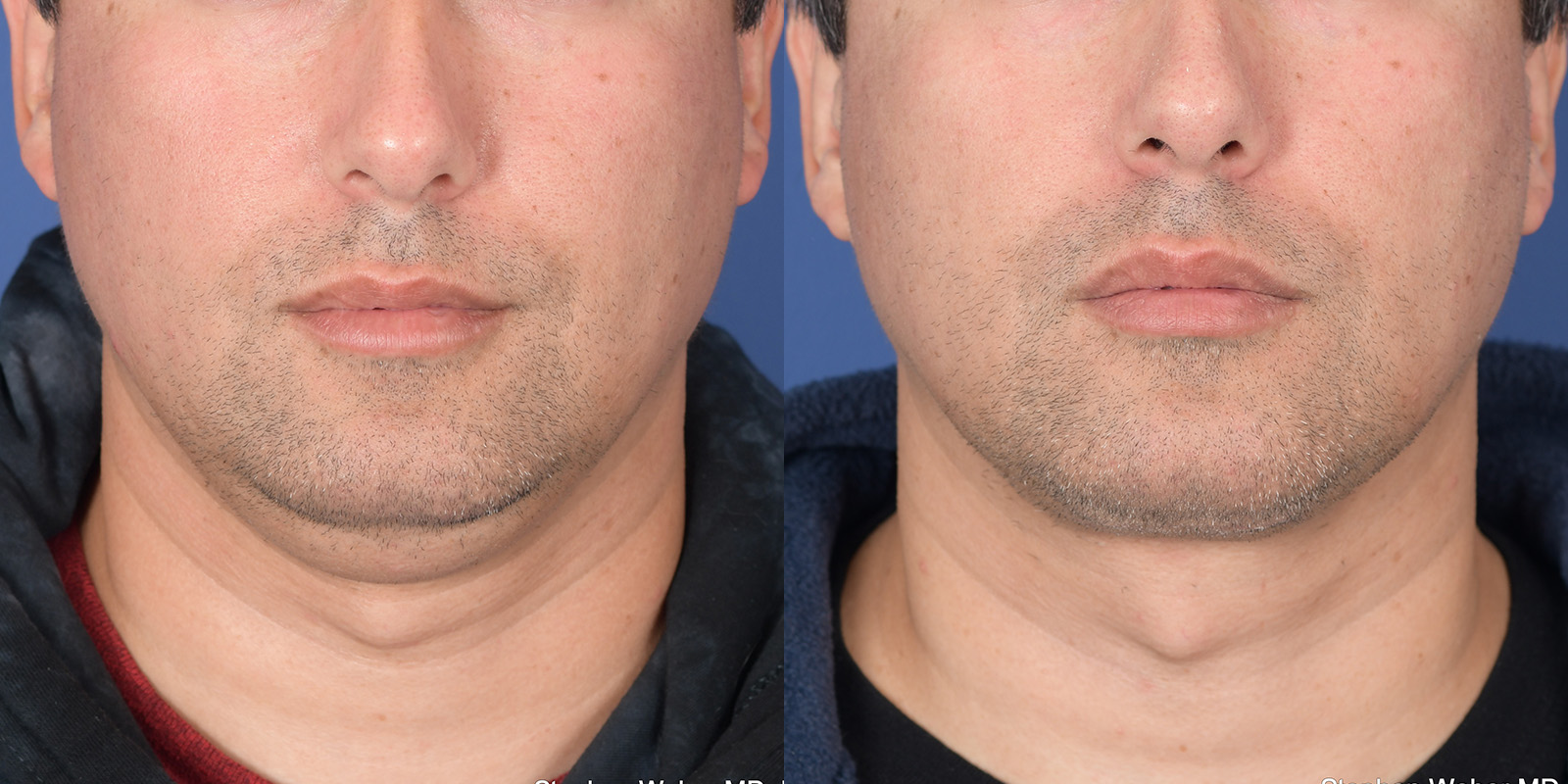 Necklift Before and After | Weber Facial Plastic Surgery