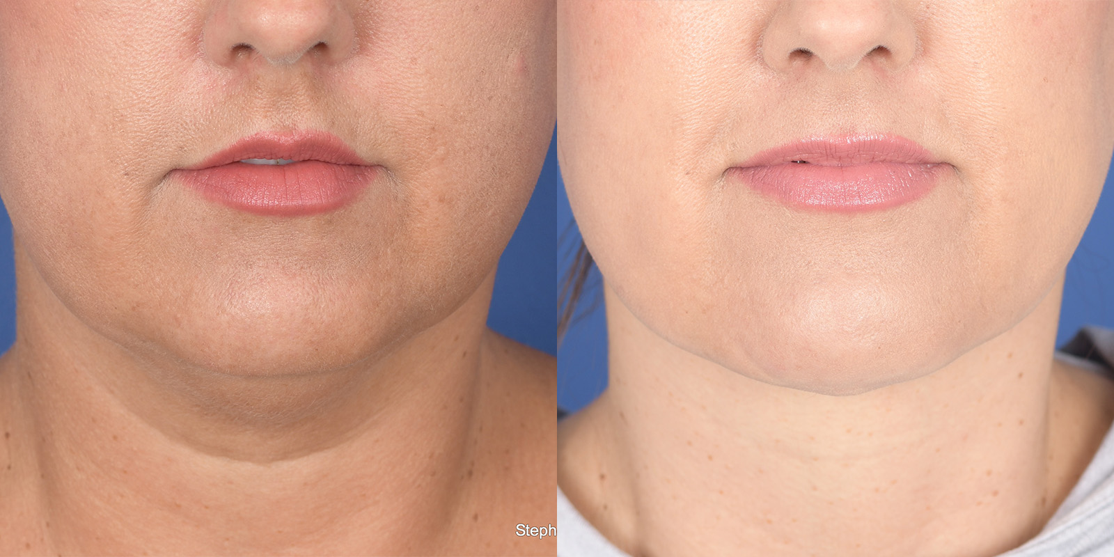 Necklift Before and After | Weber Facial Plastic Surgery