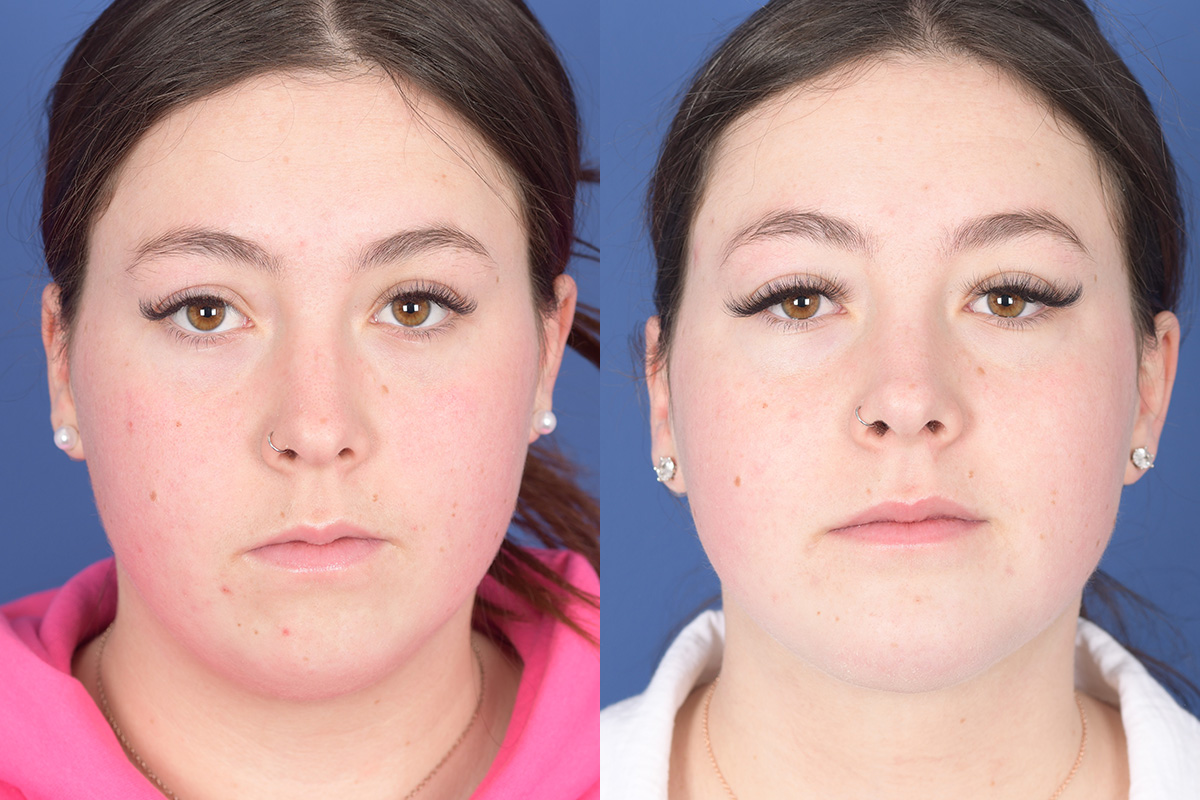 Necklift Before and After | Weber Facial Plastic Surgery