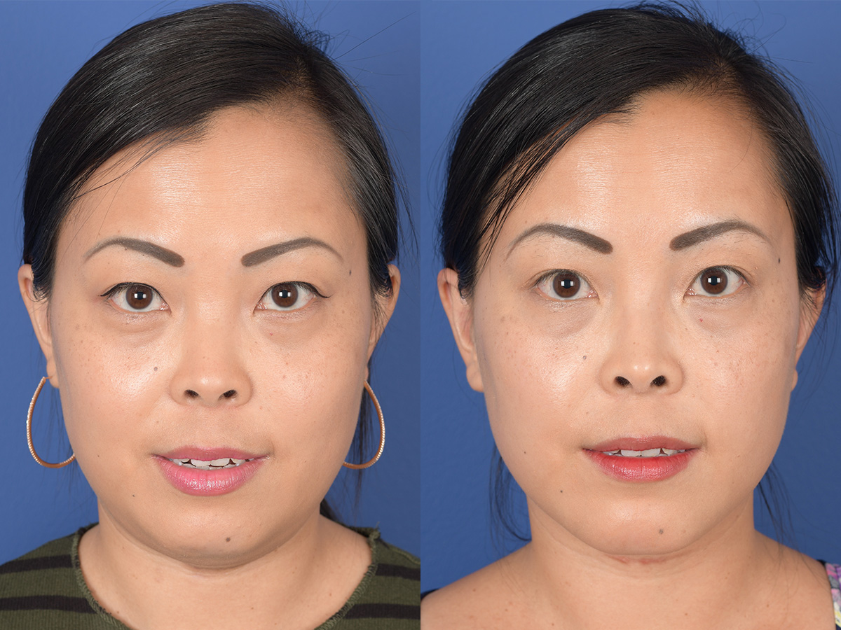 Necklift Before and After | Weber Facial Plastic Surgery