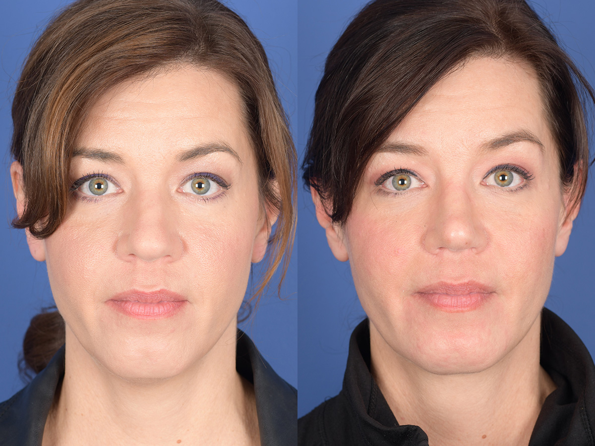 Necklift Before and After | Weber Facial Plastic Surgery