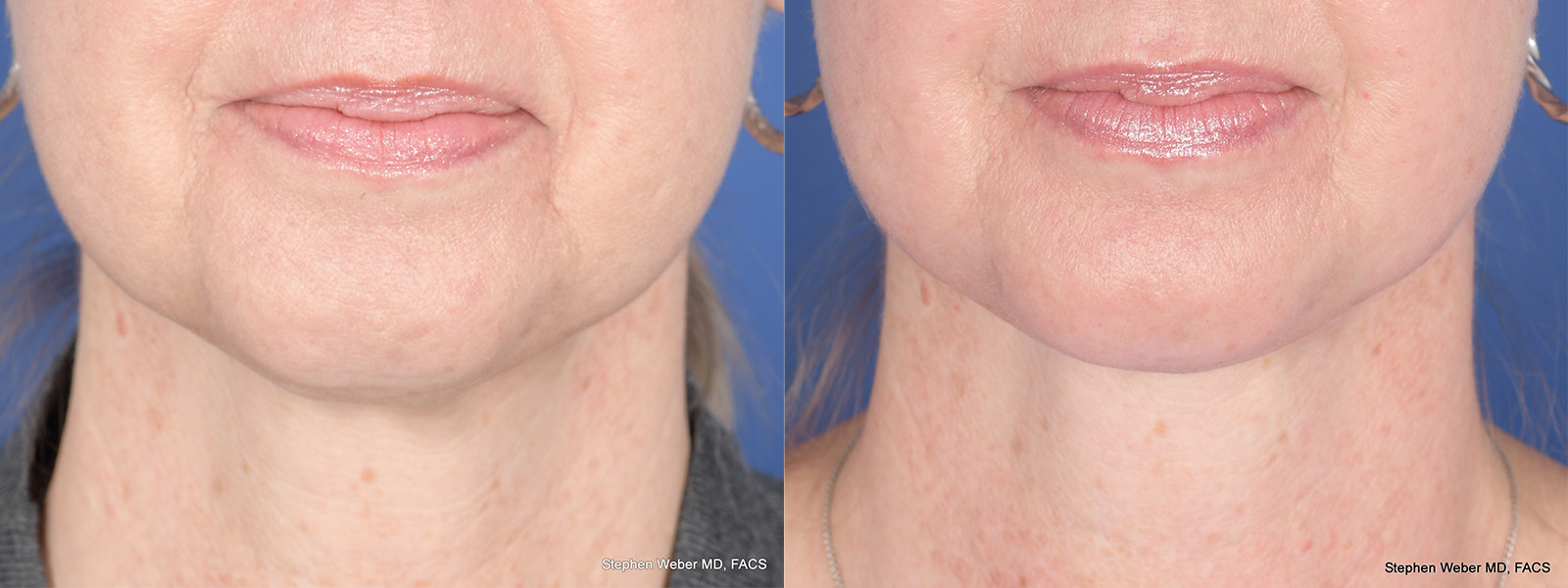 Necklift Before and After | Weber Facial Plastic Surgery