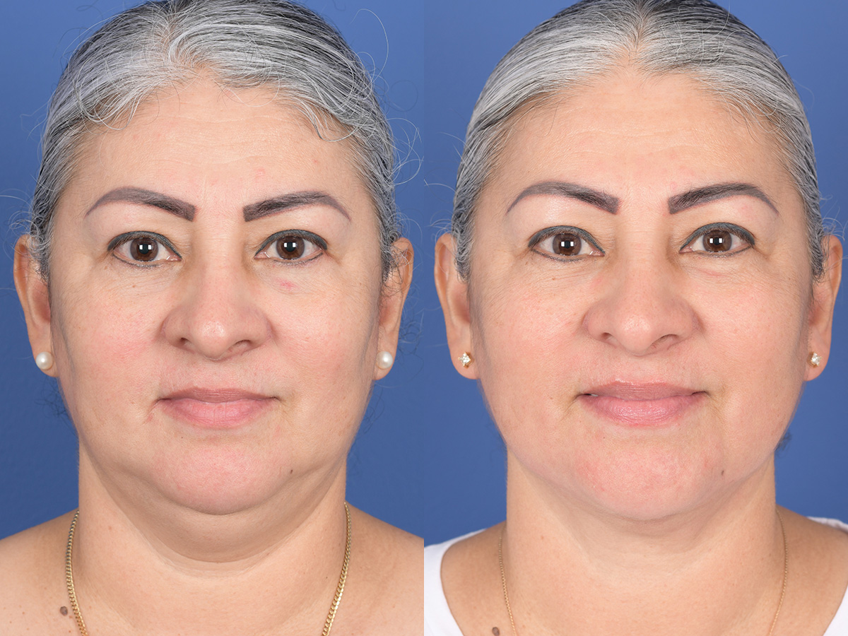 Necklift Before and After | Weber Facial Plastic Surgery