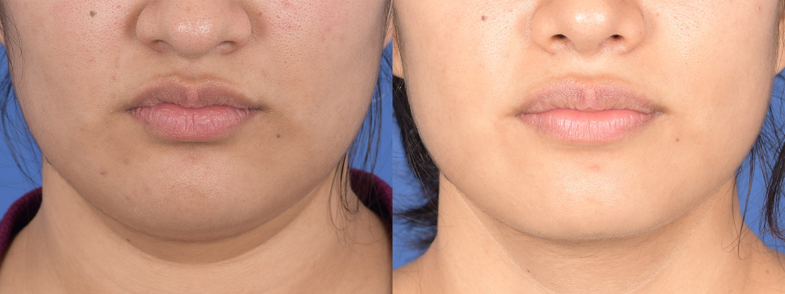 Necklift Before and After | Weber Facial Plastic Surgery