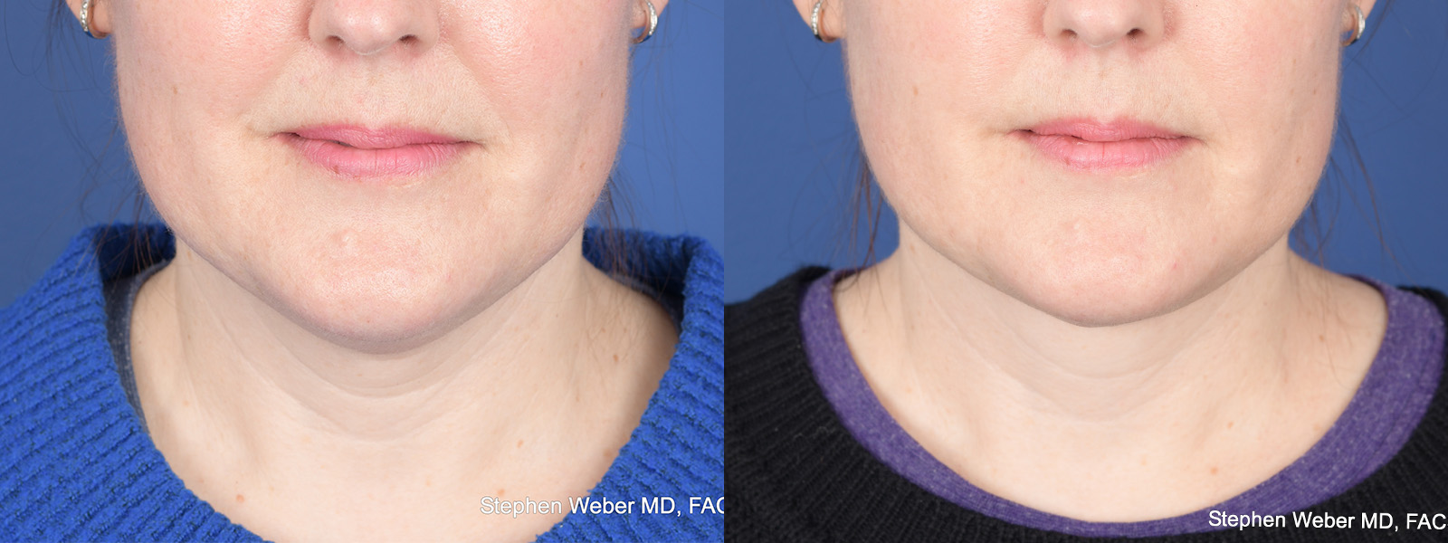 Necklift Before and After | Weber Facial Plastic Surgery