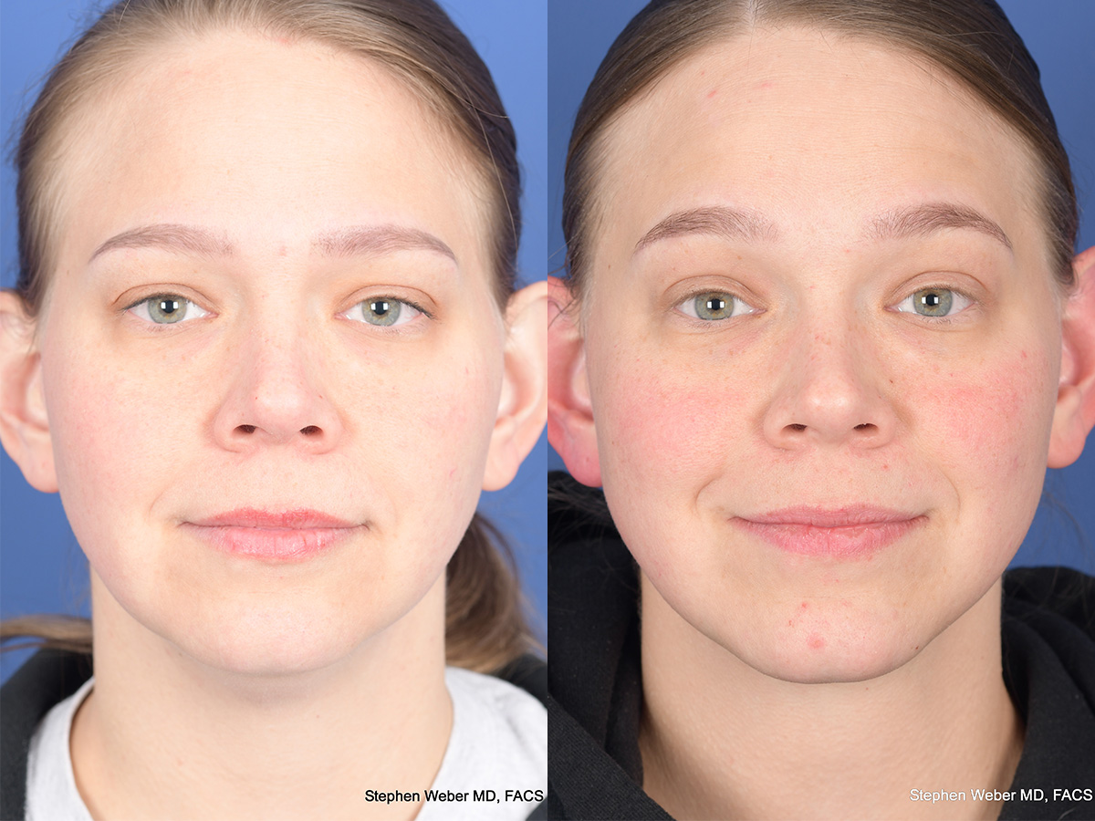 Necklift Before and After | Weber Facial Plastic Surgery