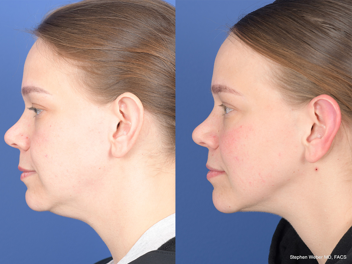 Necklift Before and After | Weber Facial Plastic Surgery