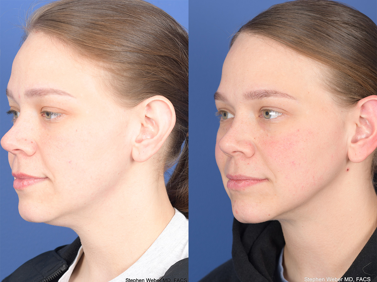 Necklift Before and After | Weber Facial Plastic Surgery