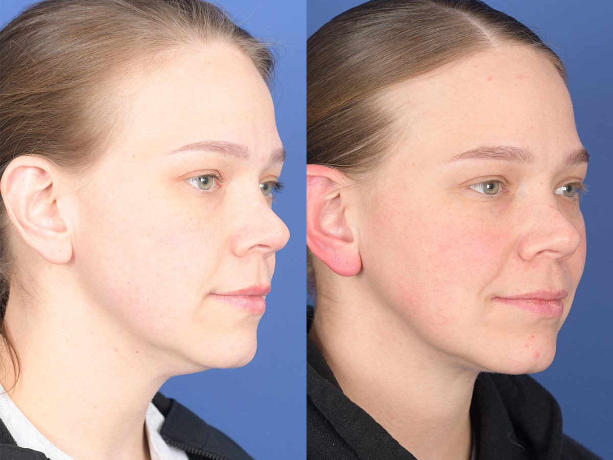 Necklift Before and After | Weber Facial Plastic Surgery