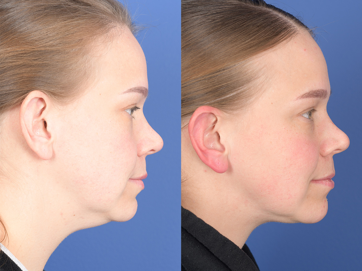 Necklift Before and After | Weber Facial Plastic Surgery