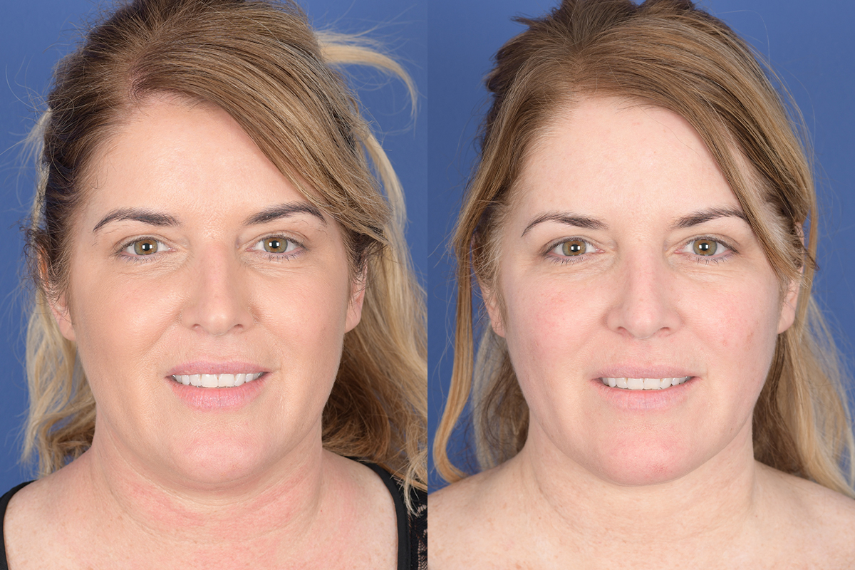 Necklift Before and After | Weber Facial Plastic Surgery