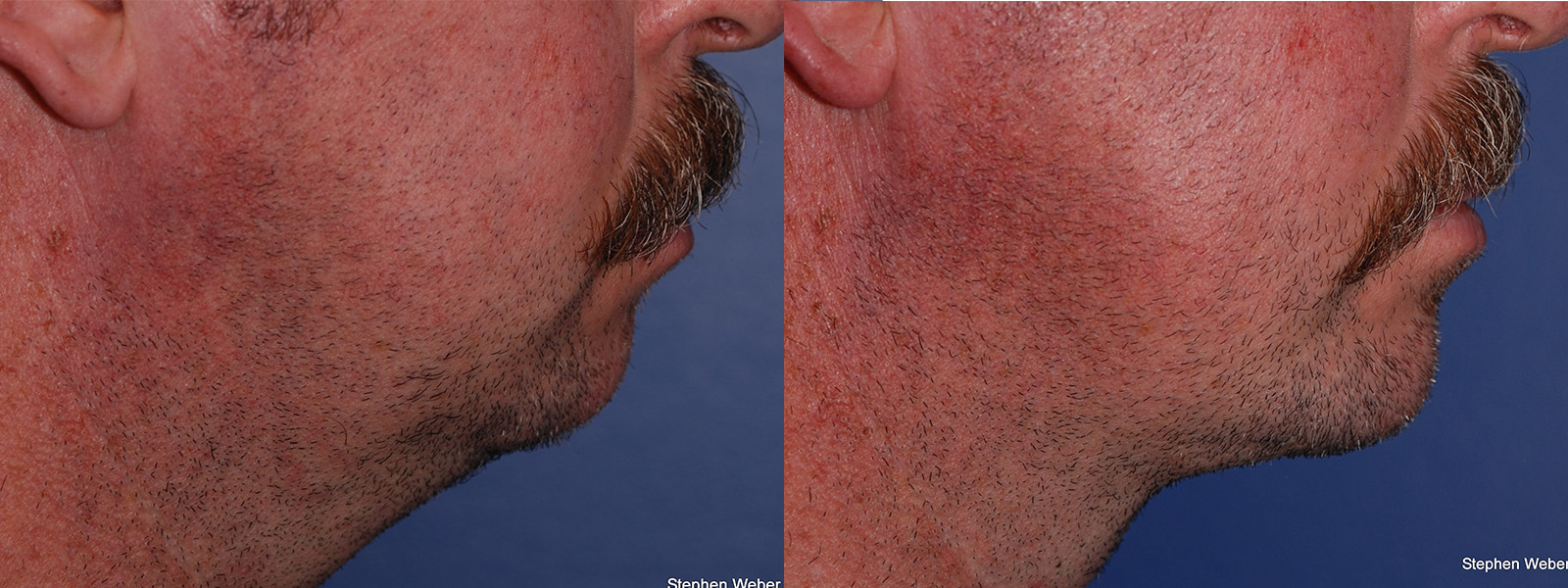 Necklift Before and After | Weber Facial Plastic Surgery