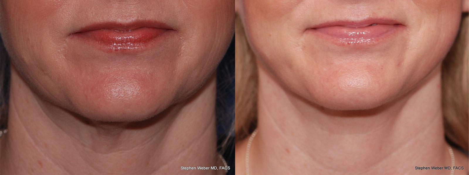 Necklift Before and After | Weber Facial Plastic Surgery