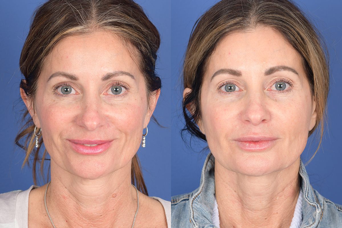 Necklift Before and After | Weber Facial Plastic Surgery