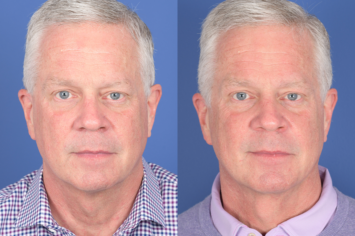 Necklift Before and After | Weber Facial Plastic Surgery