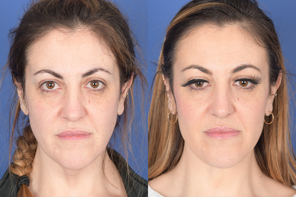 Necklift Before and After | Weber Facial Plastic Surgery
