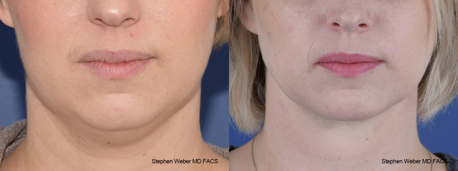 Necklift Before and After | Weber Facial Plastic Surgery