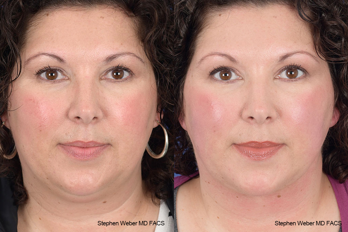 Necklift Before and After | Weber Facial Plastic Surgery