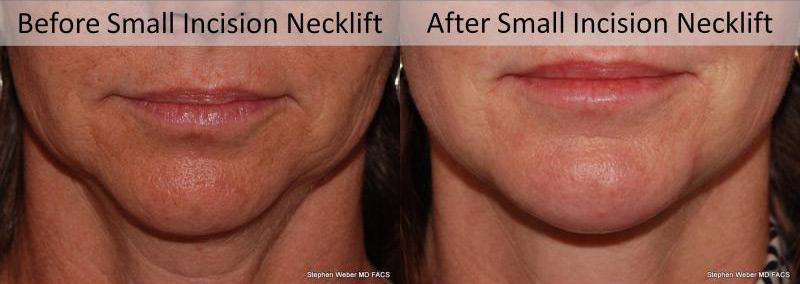 Necklift Before and After | Weber Facial Plastic Surgery