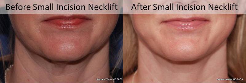 Necklift Before and After | Weber Facial Plastic Surgery