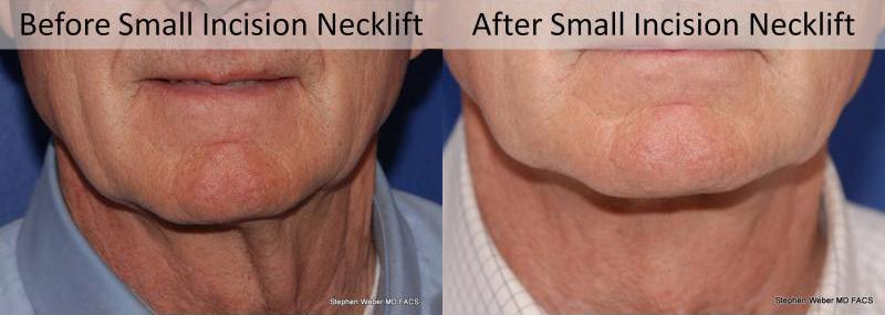 Necklift Before and After | Weber Facial Plastic Surgery
