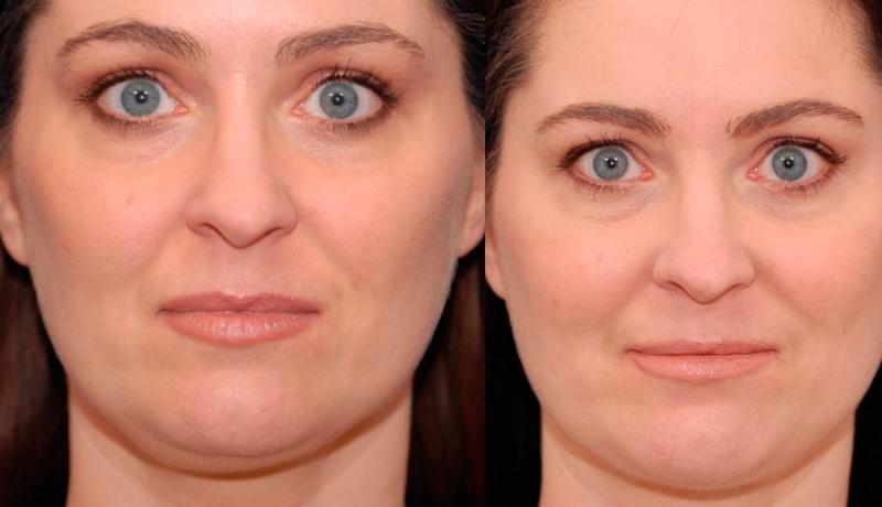 Necklift Before and After | Weber Facial Plastic Surgery