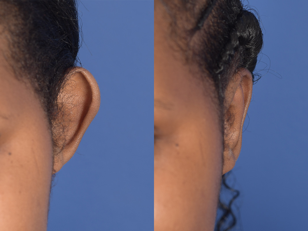 Otoplasty Before and After | Weber Facial Plastic Surgery