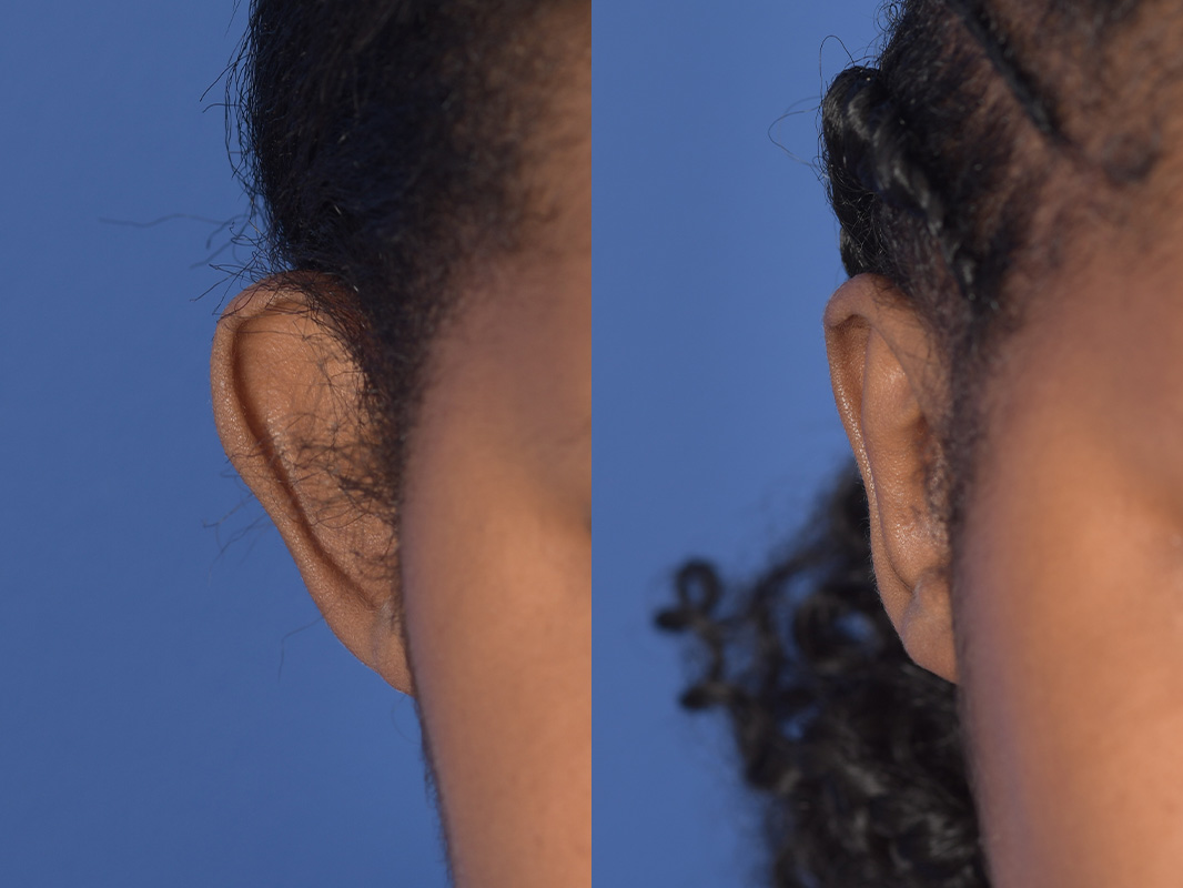 Otoplasty Before and After | Weber Facial Plastic Surgery