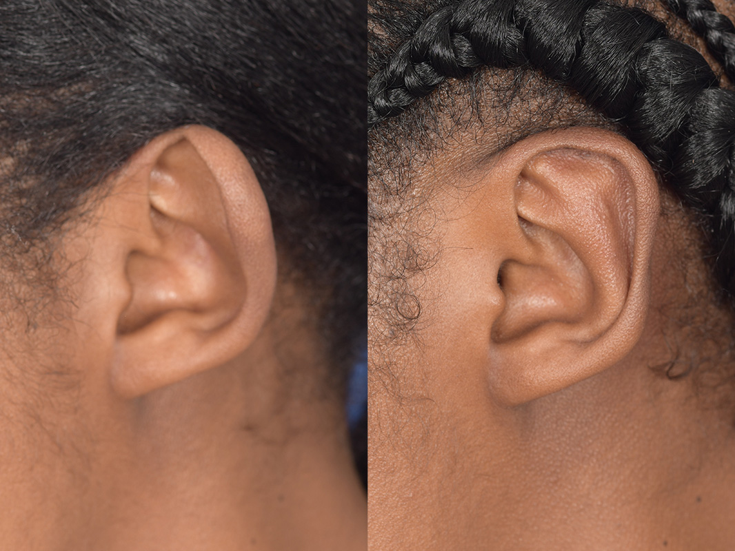 Otoplasty Before and After | Weber Facial Plastic Surgery