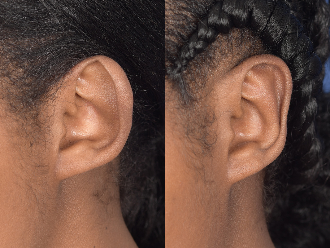 Otoplasty Before and After | Weber Facial Plastic Surgery