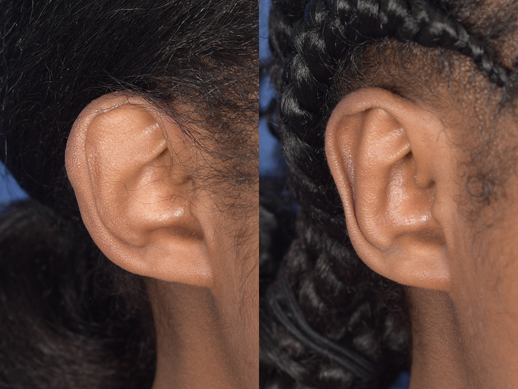 Otoplasty Before and After | Weber Facial Plastic Surgery