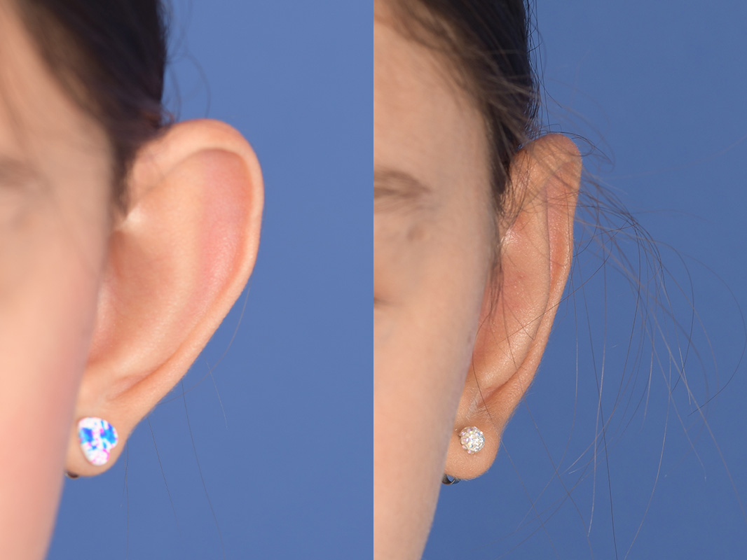 Otoplasty Before and After | Weber Facial Plastic Surgery