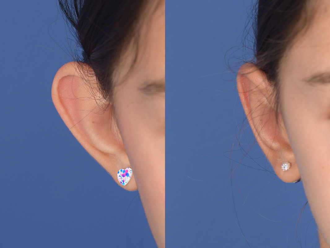 Otoplasty Before and After | Weber Facial Plastic Surgery