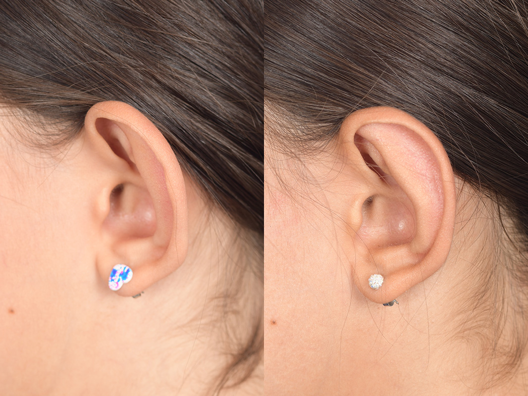 Otoplasty Before and After | Weber Facial Plastic Surgery
