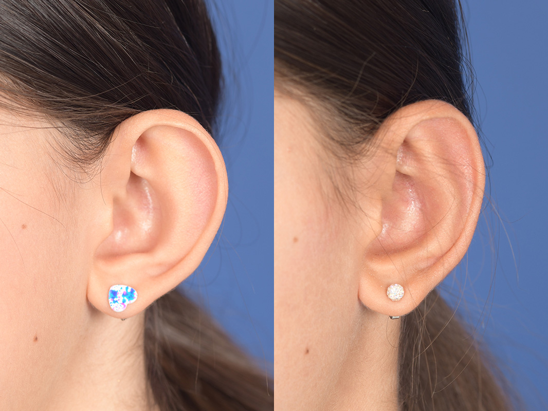 Otoplasty Before and After | Weber Facial Plastic Surgery