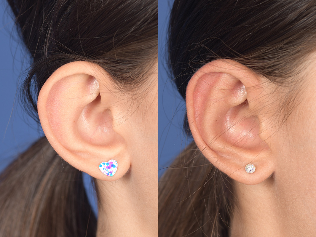 Otoplasty Before and After | Weber Facial Plastic Surgery